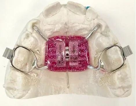 Несъемные детские ортодонтические аппараты